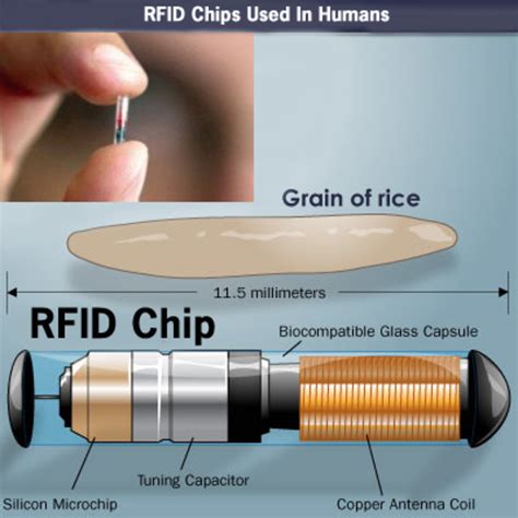 dermatologist removing rfid chip|What Kind of Surgery Would Be Necessary to Remove an RFID .